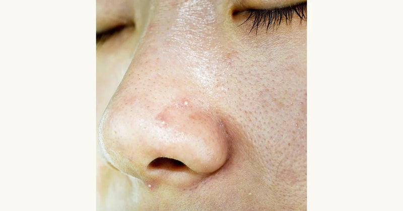 DIY Blackhead Removal: Honey, Flour, and Warm Water Solution - Beessential